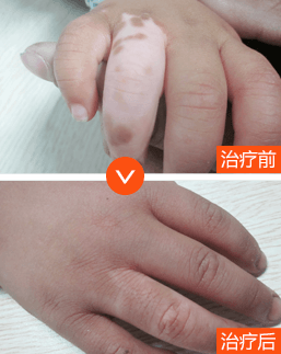 儿童手部白癜风治疗前后对比图